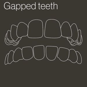gapped-teeth-outline