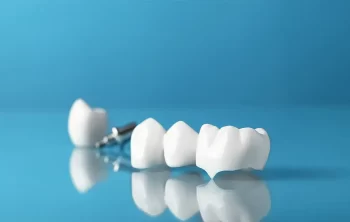 The Benefits of Choosing Dental Crowns in Mississauga for Restorative Treatment